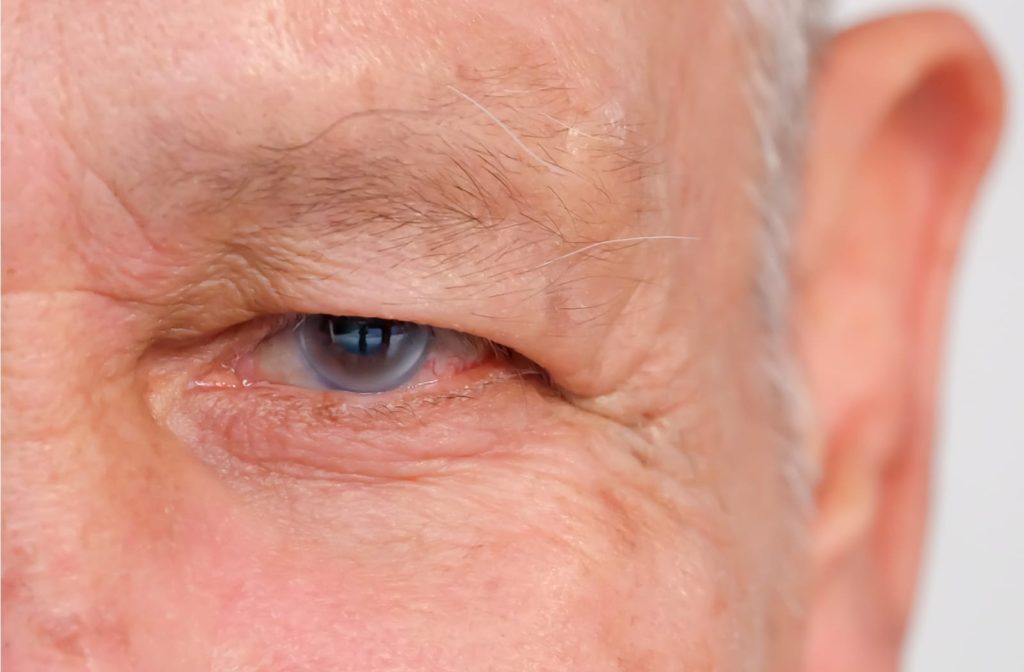 A close up of an elderly man's left eye with glaucoma