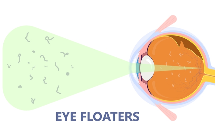 A diagram illustrating what happens in the eye to cause you to see eye floaters