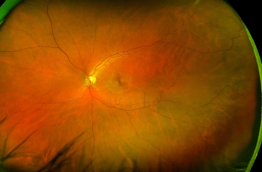 A retinal image from Optomap technology showing an ultra-wide field of view.