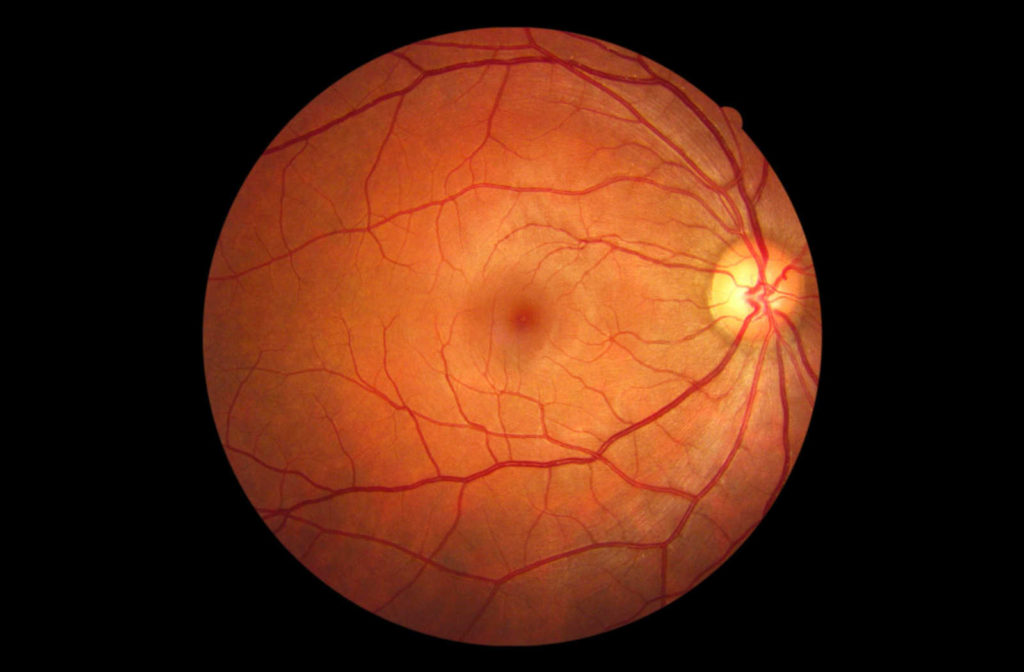 A retinal image from traditional retinal photography.