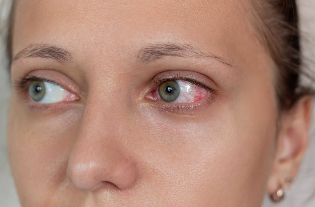 Close-up of female eyes with red dry eyes while using contact lenses.