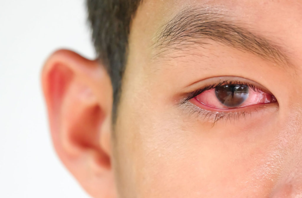 A close-up of an irritated eye worsened by rubbing.