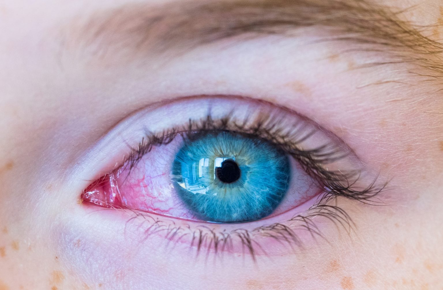 A Man's Eyes Were Stained Blue After He Took An Antibiotic To Treat  Inflammation