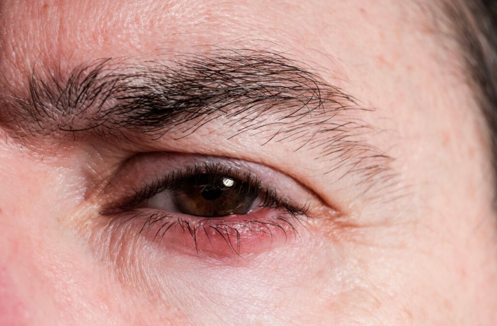 A close up of a red, irritated eye caused by dry eye